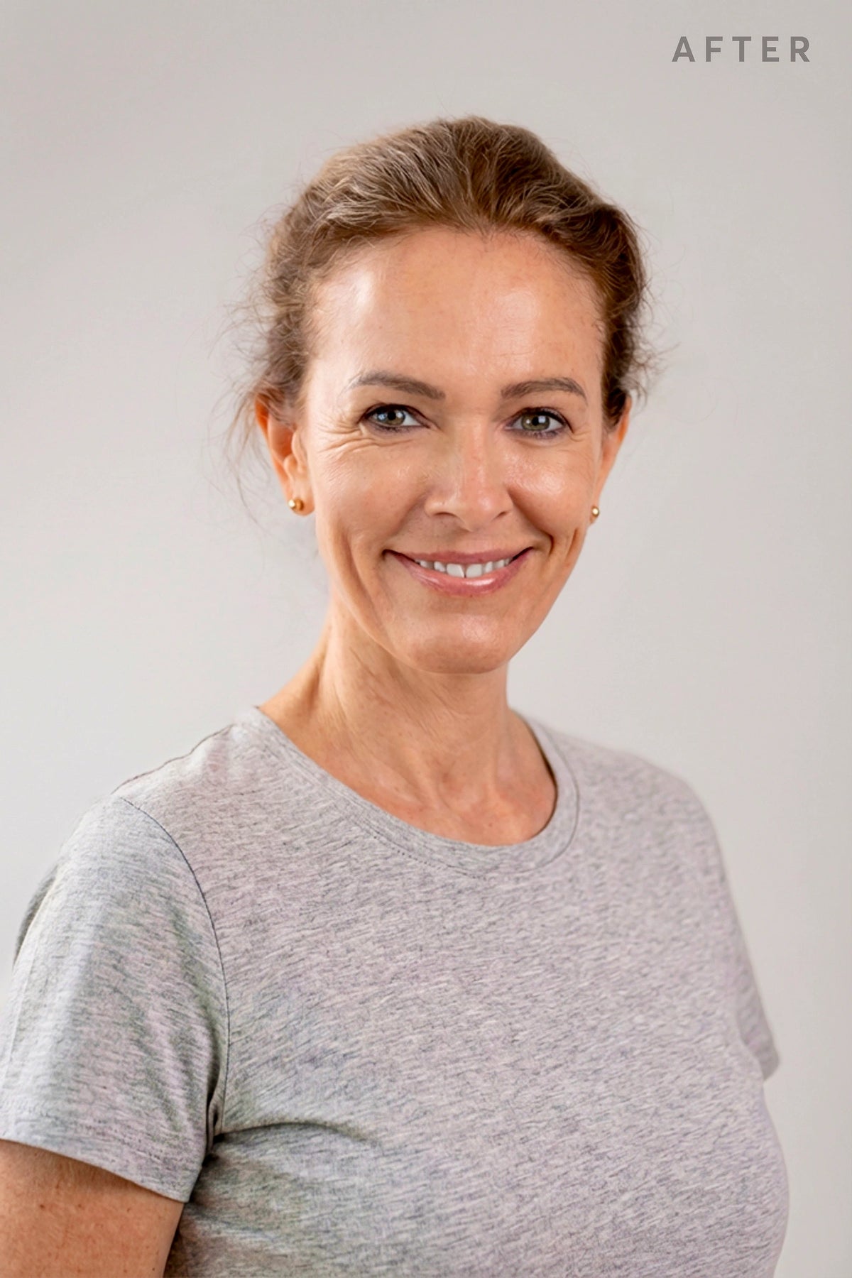 Portrait of a mature woman after under-eye treatment showing reduced wrinkles and dark circles.